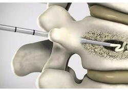 Медицинский НИИ&nbsp;сделал прорыв в&nbsp;исследовании костной хирургии с&nbsp;новым костным цементом